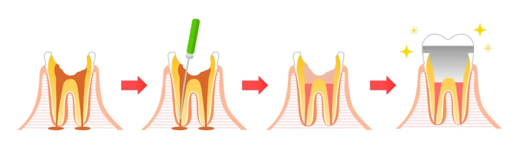 Dévitalisation - traitement endodontique - dentiste à Septeuil 