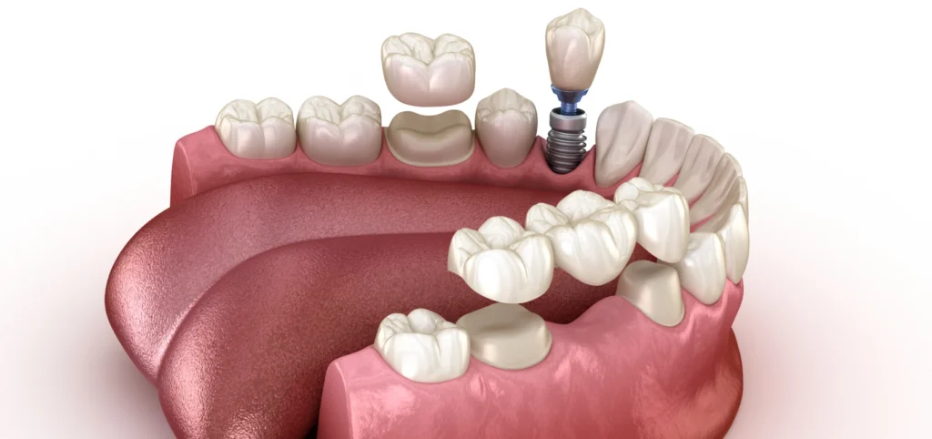 Implants dentaires