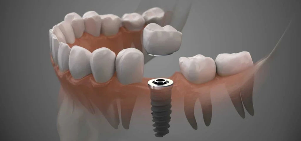 Dentiste à Montchauvet : implants dentaires