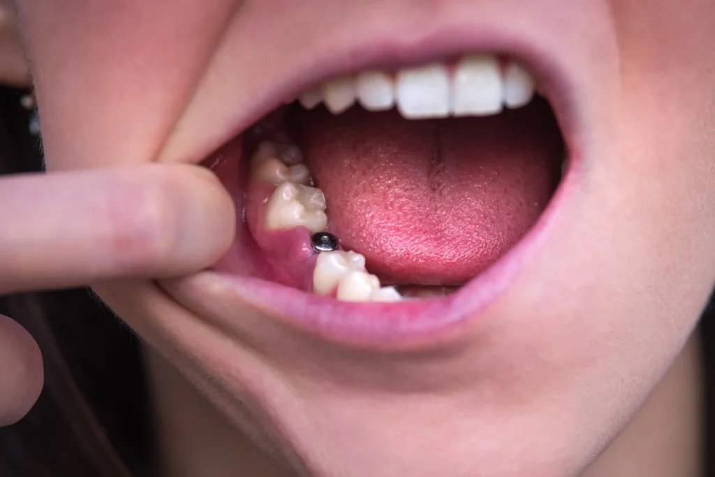 Dentiste à Thoiry : implants dentaires