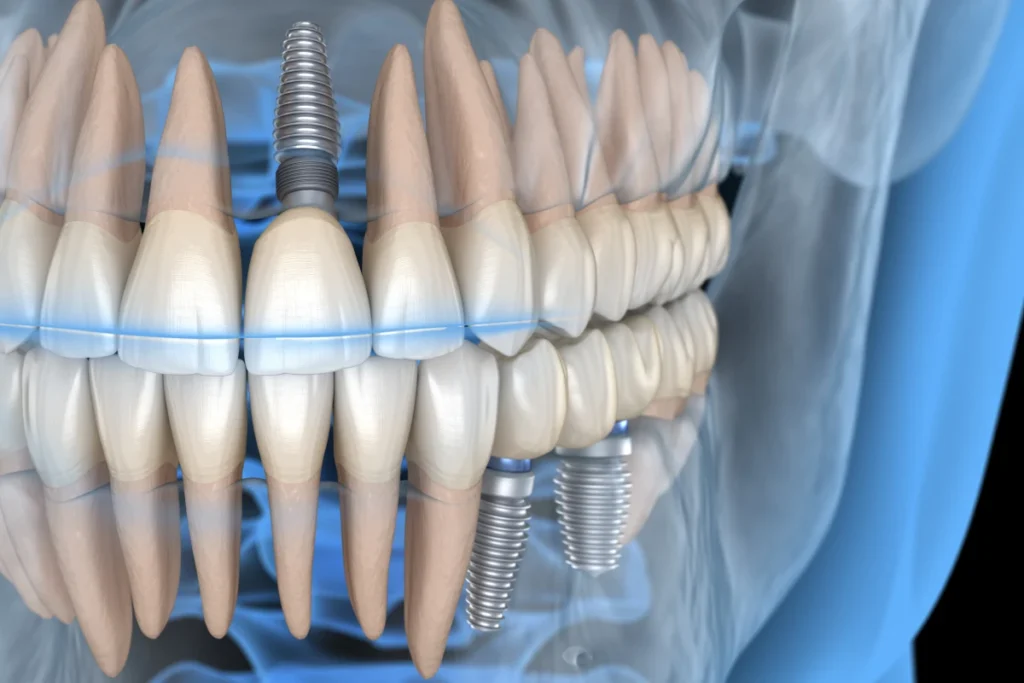 Dentiste à Guerville : implants dentaires