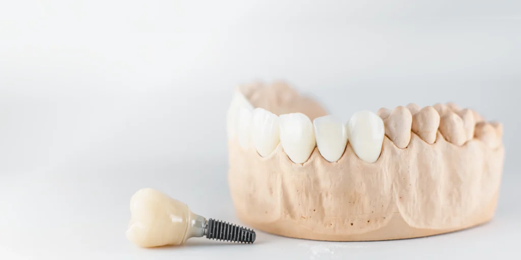 Dentiste Magnanville implants dentaires