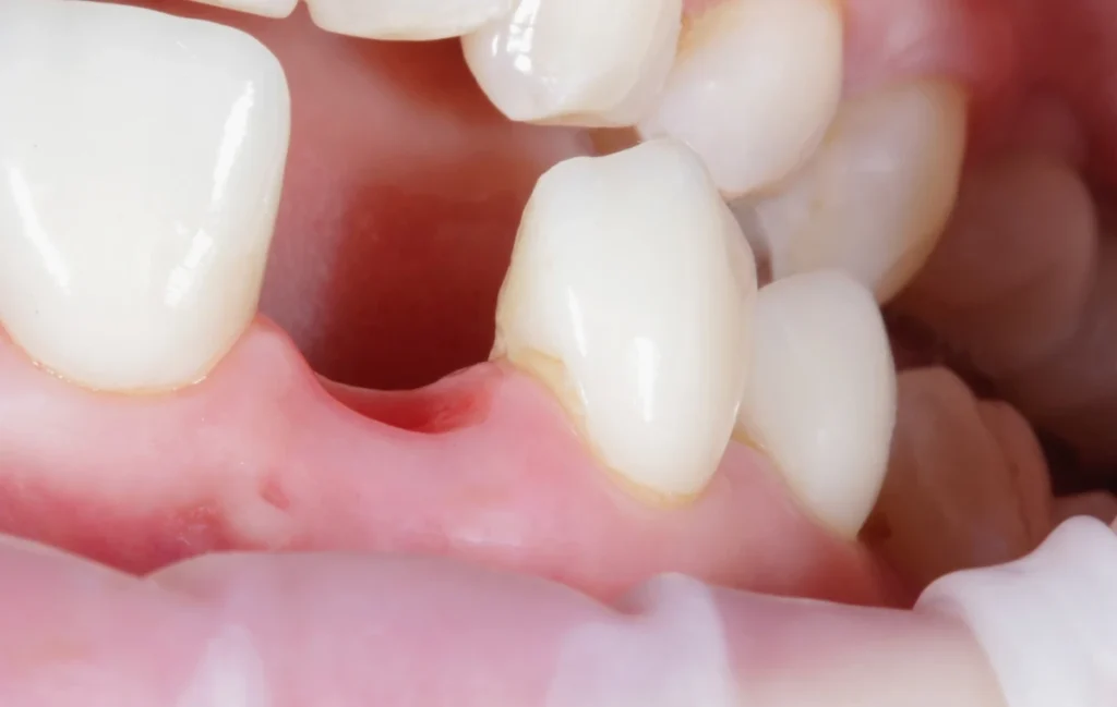 Dentiste à Thoiry : implants dentaires