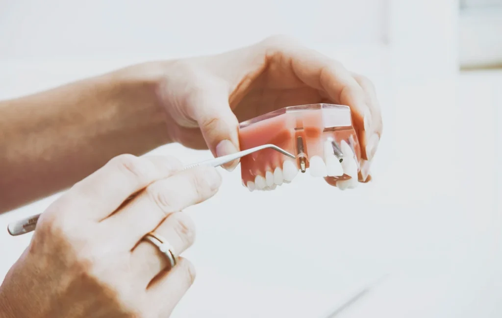 Dentiste à Montchauvet : implants dentaires